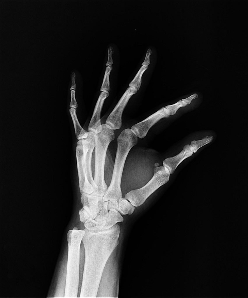 x-ray, medical treatment, arm, doctor, medicine, bone, hospital, medical insurance, diagnosis, x-ray, x-ray, x-ray, x-ray, x-ray, bone